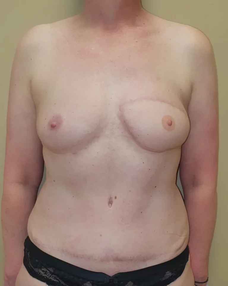 Reconstruction secondaire par lambeau DIEP, seins et abdomen, vue de face, après (résultat à environ 1 an)