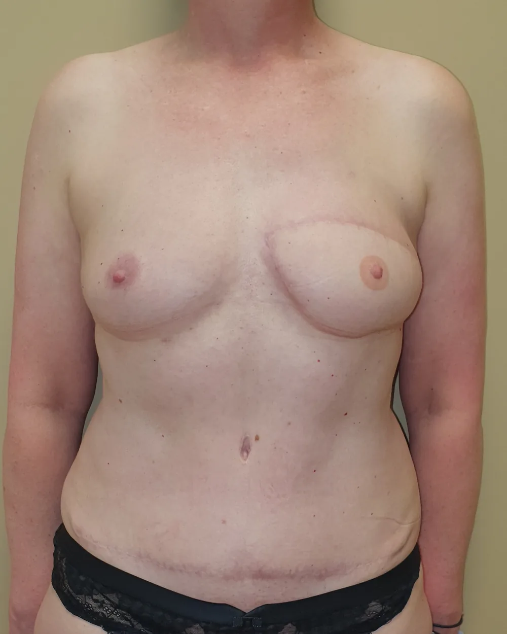 Reconstruction secondaire par lambeau DIEP, seins et abdomen, vue de face, après (résultat à environ 1 an)