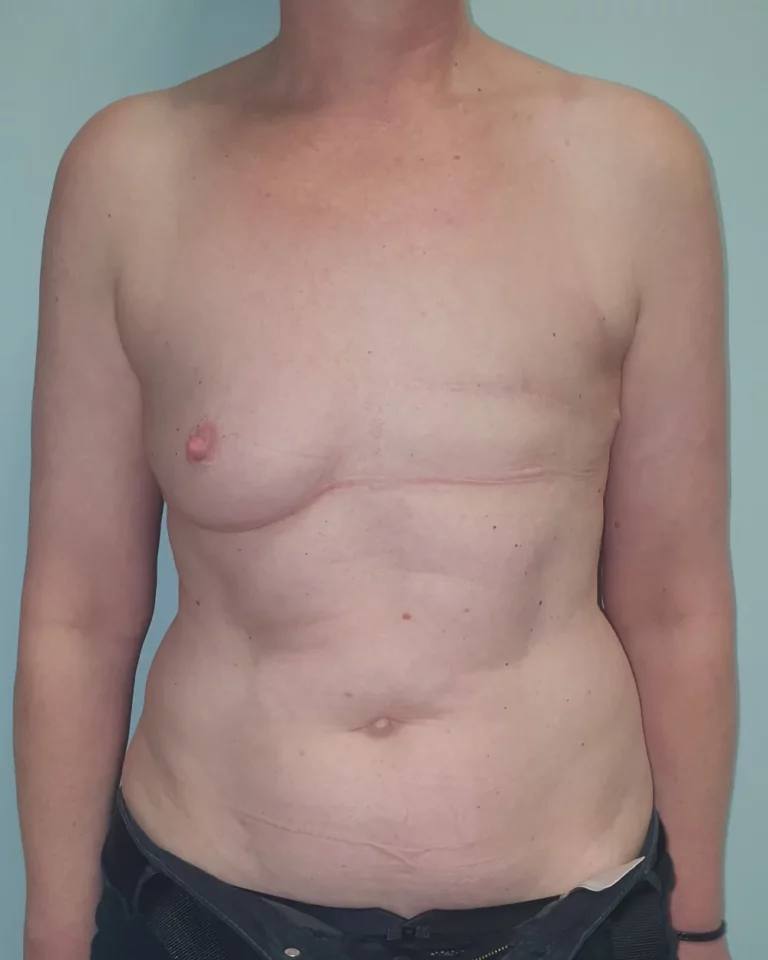 Reconstruction secondaire par lambeau DIEP, seins et abdomen, vue de face, avant