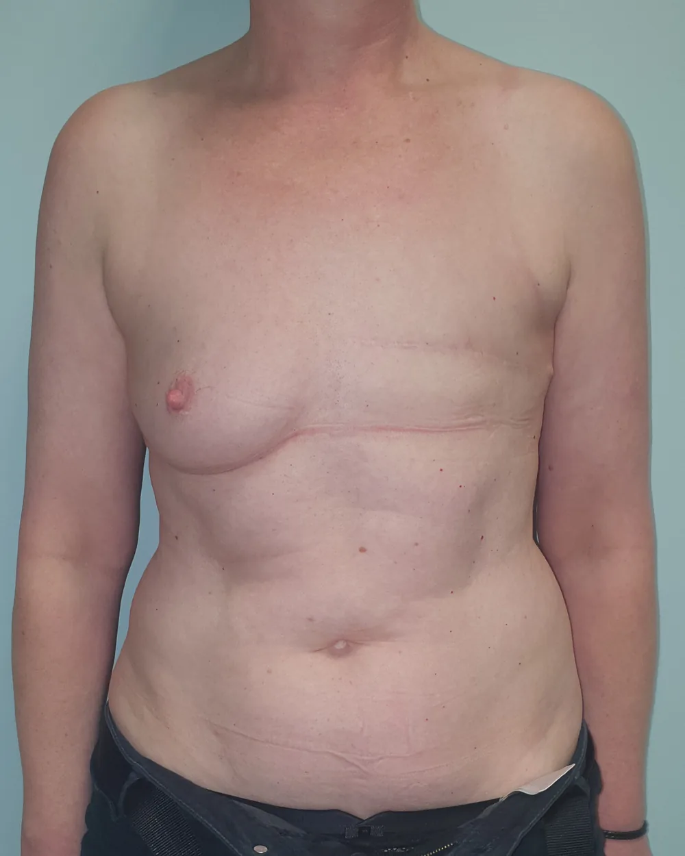 Reconstruction secondaire par lambeau DIEP, seins et abdomen, vue de face, avant