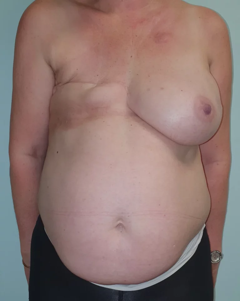 Reconstruction secondaire par lambeau DIEP, seins et abdomen, vue de face, avant