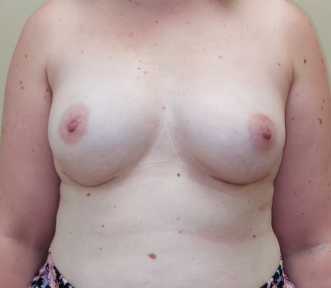 Mastectomie prophylactique et reconstruction immédiate par prothèses, seins, vue de face, après (résultat à environ 1 an)