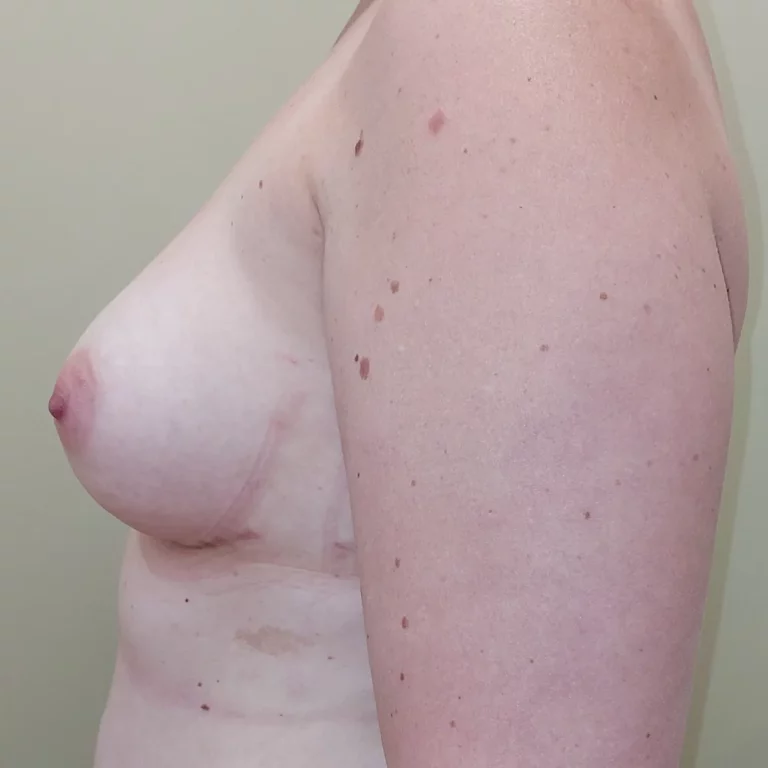 Mastectomie prophylactique et reconstruction immédiate par prothèses, sein gauche, vue de profil, après (résultat à environ 1 an)