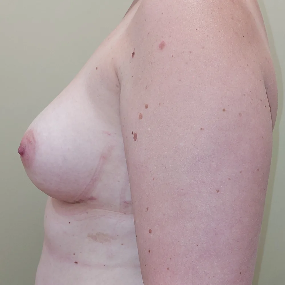 Mastectomie prophylactique et reconstruction immédiate par prothèses, sein gauche, vue de profil, après (résultat à environ 1 an)