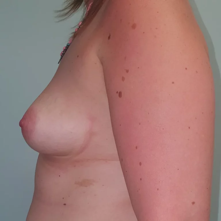 Mastectomie prophylactique et reconstruction immédiate par prothèses, sein gauche, vue de profil, avant