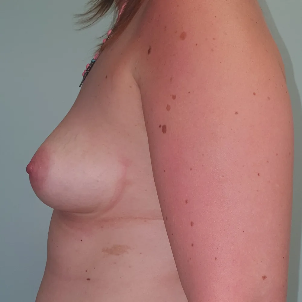 Mastectomie prophylactique et reconstruction immédiate par prothèses, sein gauche, vue de profil, avant