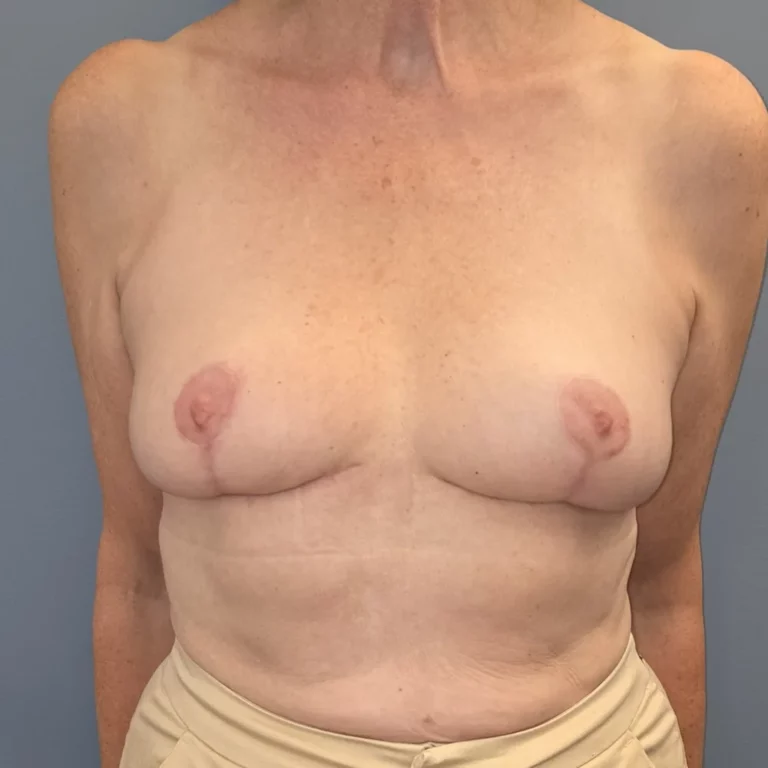 Réduction mammaire, seins, vue de face, après (résultat à environ 6 mois)