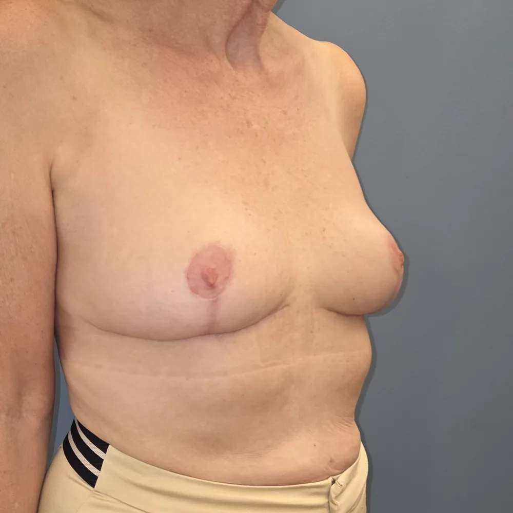 Réduction mammaire, seins, vue oblique droite, après (résultat à environ 6 mois)