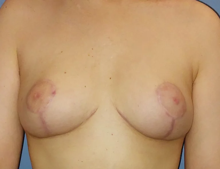 Réduction mammaire, seins, vue de face, après (résultat à environ 5 mois)