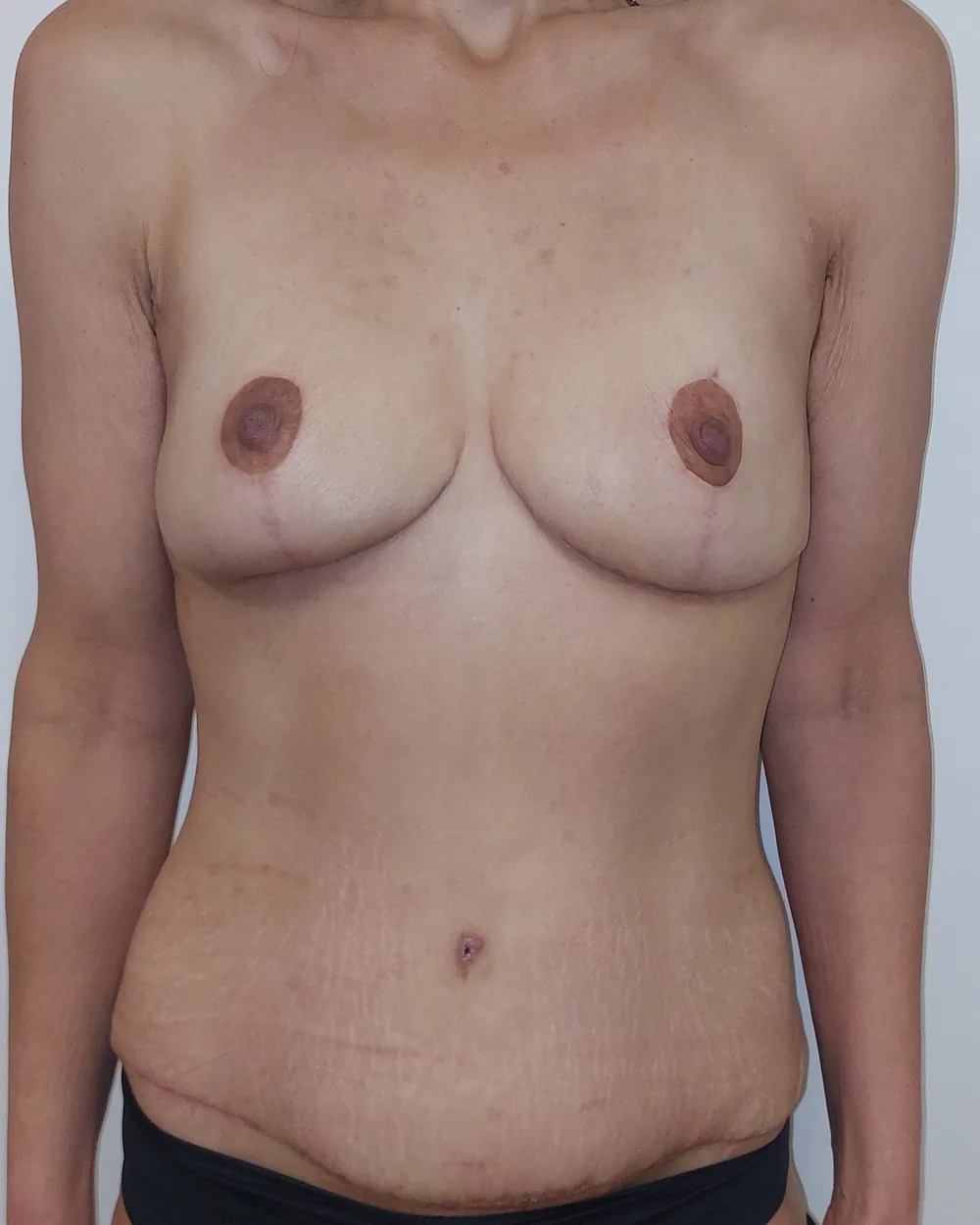 Mastectomie prophylactique et reconstruction immédiate par double lambeau DIEP, seins et abdomen, vue de face, après (résultat à environ 2 ans)