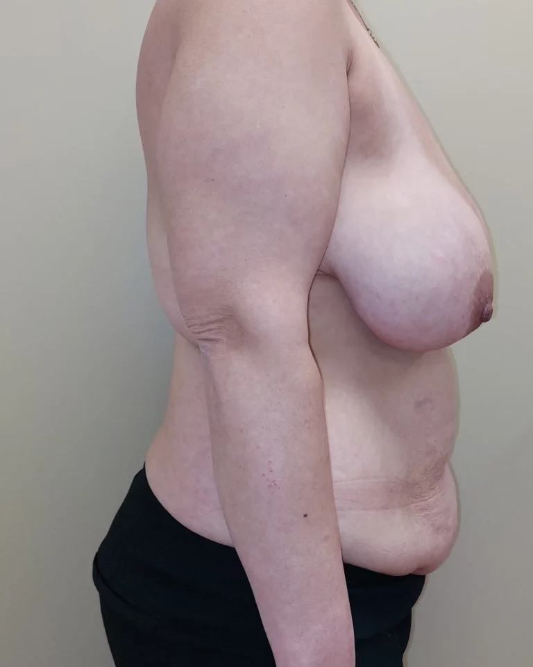Mastectomie prophylactique et reconstruction immédiate par double lambeau DIEP, seins, vue de profil gauche, avant