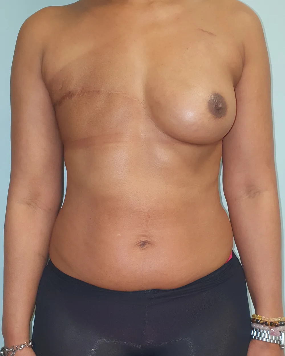 Reconstruction secondaire par lambeau DIEP, seins et abdomen, vue de face, avant