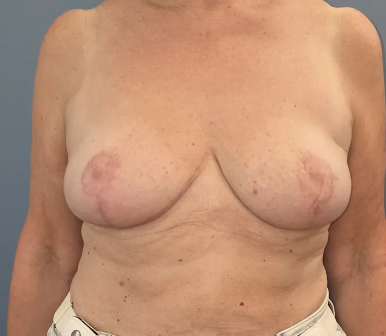 Réduction mammaire, seins, vue de face, après (résultat à environ 6 mois)
