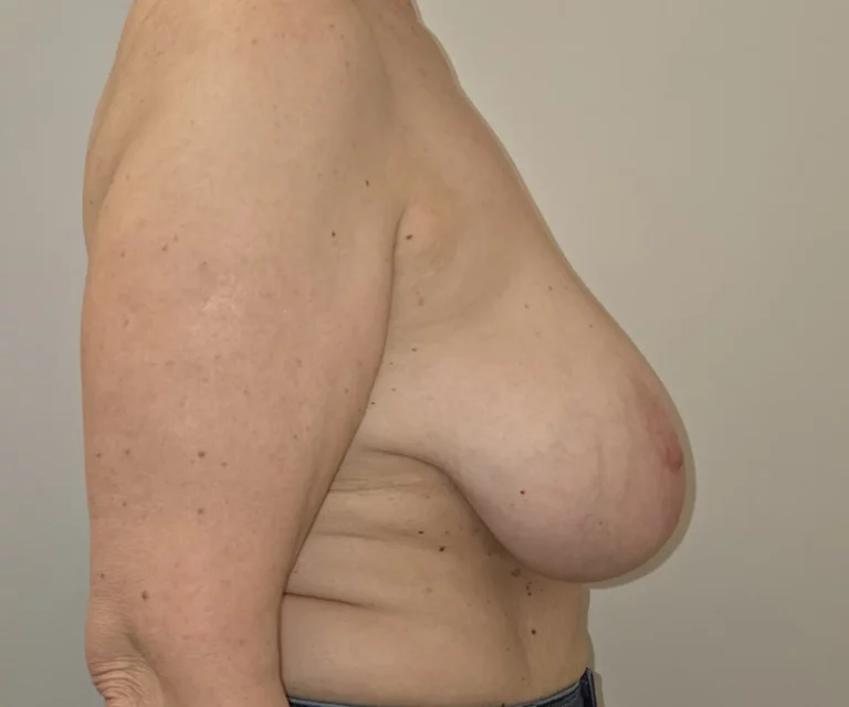 Réduction mammaire, sein droit, vue de profil, avant