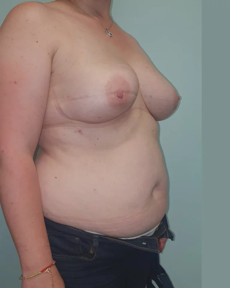 Remplacement d'une reconstruction par prothèse par un lambeau DIEP, seins, vue de trois-quarts droite, avant