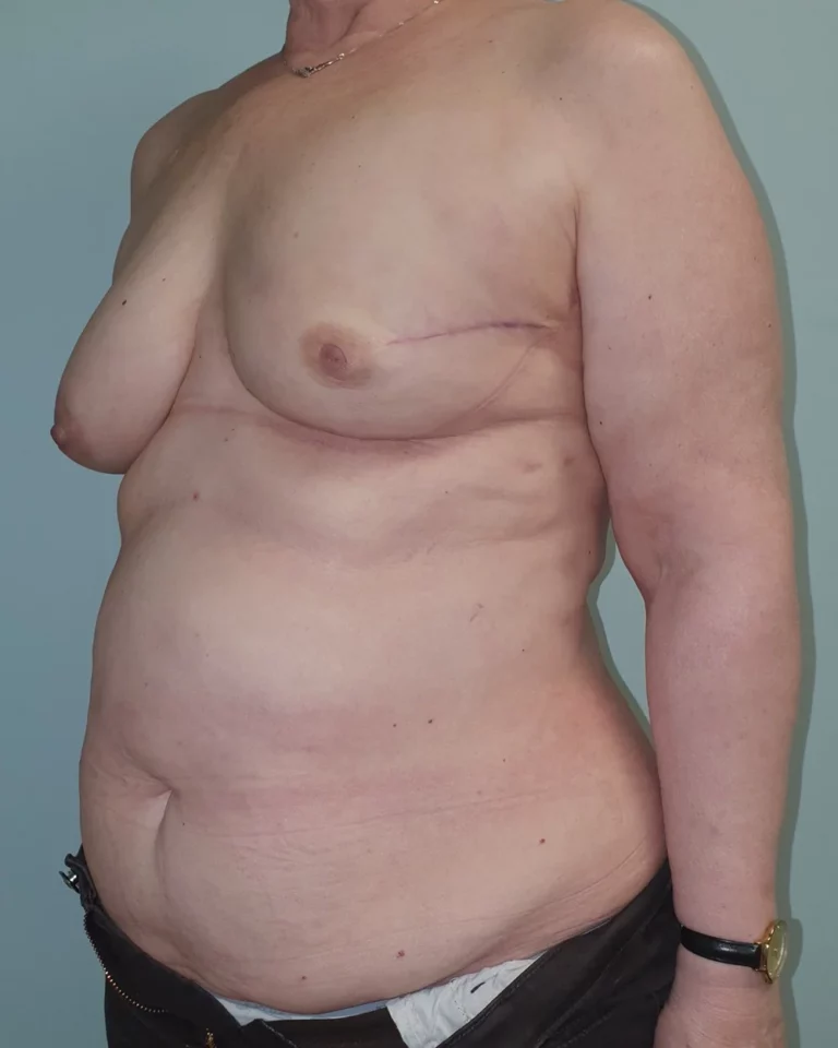 Mastectomie gauche et reconstruction immédiate par lambeau DIEP, seins, vue de trois-quarts gauche, avant