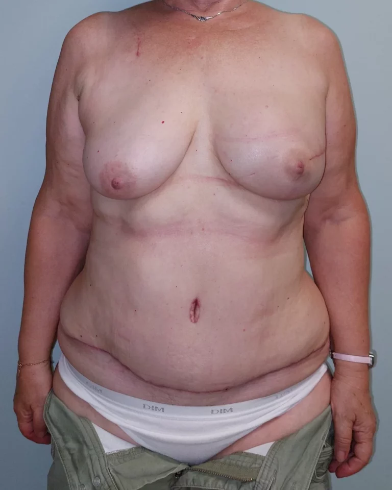 Mastectomie gauche et reconstruction immédiate par lambeau DIEP, seins et abdomen, vue de face, après (résultat à quelques mois)