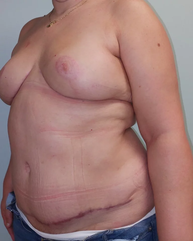 Mastectomie prophylactique et reconstruction immédiate par double lambeau DIEP, seins, vue de trois-quarts gauche, après (résultat à environ 1 an)