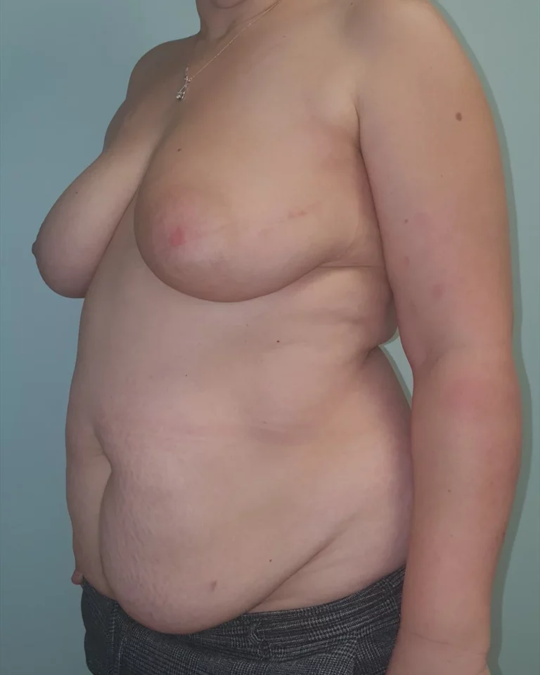 Mastectomie prophylactique et reconstruction immédiate par double lambeau DIEP, seins, vue de trois-quarts gauche, avant